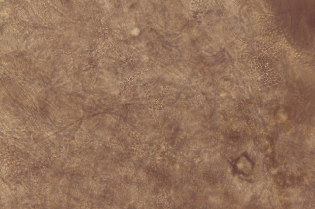 Fungo dell'unghia visto a microscopio (esame micologico diretto): ife miceliali e spore