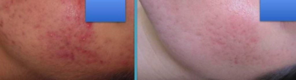 Guancia di una Paziente affetta da acne prima della cura acne e 12 mesi dopo il termine della cura acne