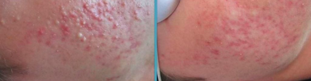 Viso di una Paziente affetta da acne prima della cura e 14 giorni dopo l'inizio della cura