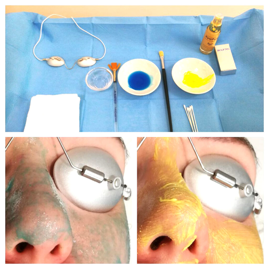 Prodotti per peeling viso e loro applicazione sulla pelle di una giovane Paziente con acne (peeling viso per acne)