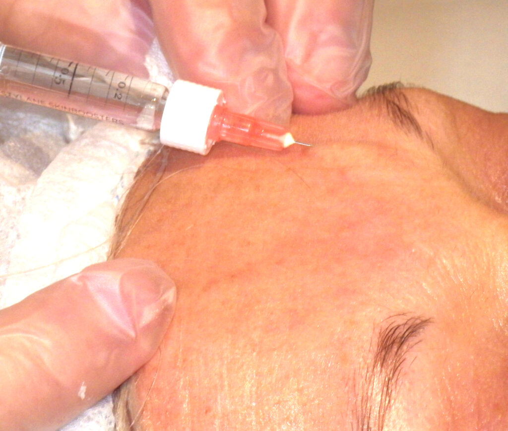 Biorivitalizzazione viso: trattamento estetico viso con iniezione sulla fronte di una Paziente nello Studio Medico Serini