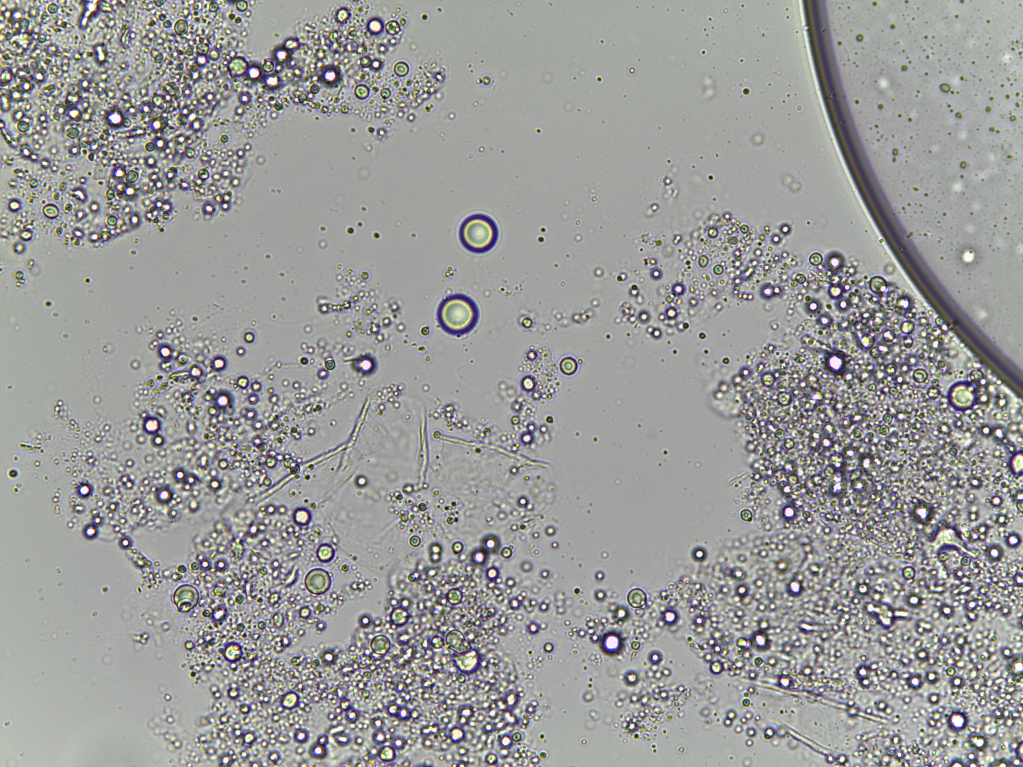 Esame microscopico micologico diretto mostrante spore in ammassi e pseudomicelio in un caso di pitiriasi versicolor
