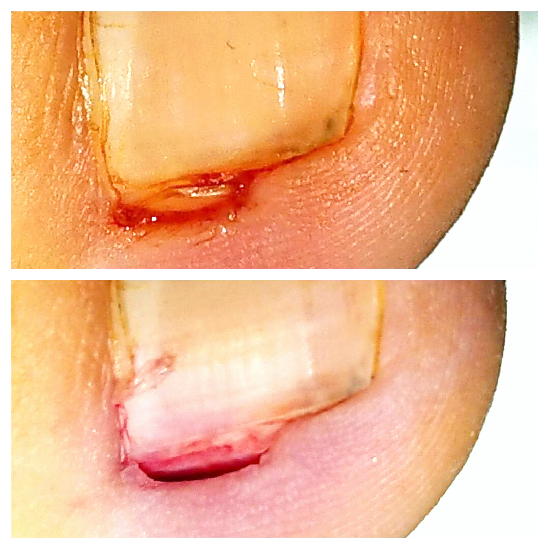 Perionissi da unghia incarnita prima e dopo intervento di rimozione unghia incarnita