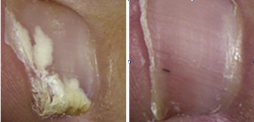 Unghia con fungo (micosi dell'unghia, onicomicosi) prima e dopo terapia fotodinamica