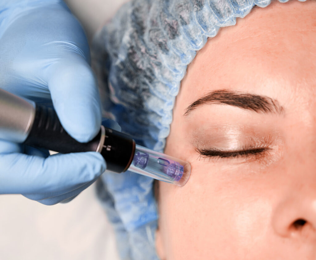 Una Paziente si sottopone a trattamento estetico viso con microneedling in zona perioculare per ringiovanimento viso