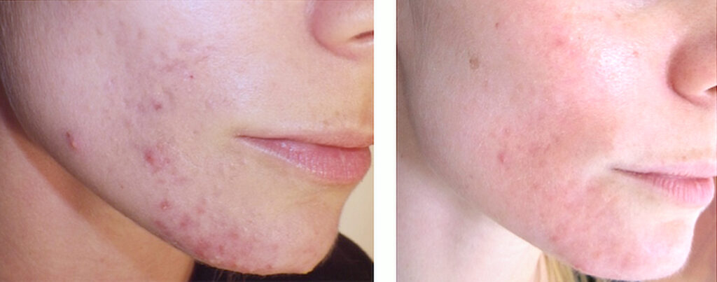 Guancia di una Paziente con acne prima della terapia e dopo una seduta di terapia fotodinamica per trattamento acne