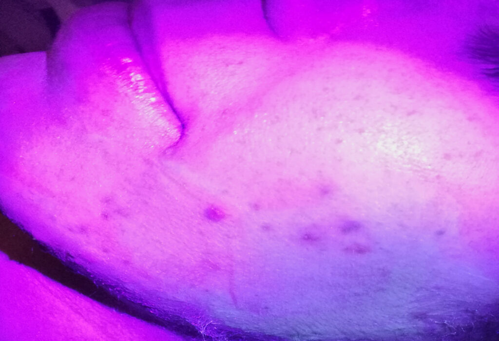 Guancia di una Paziente illuminata con luce ultravioletta per mostrare la fluorescenza dei brufoli
