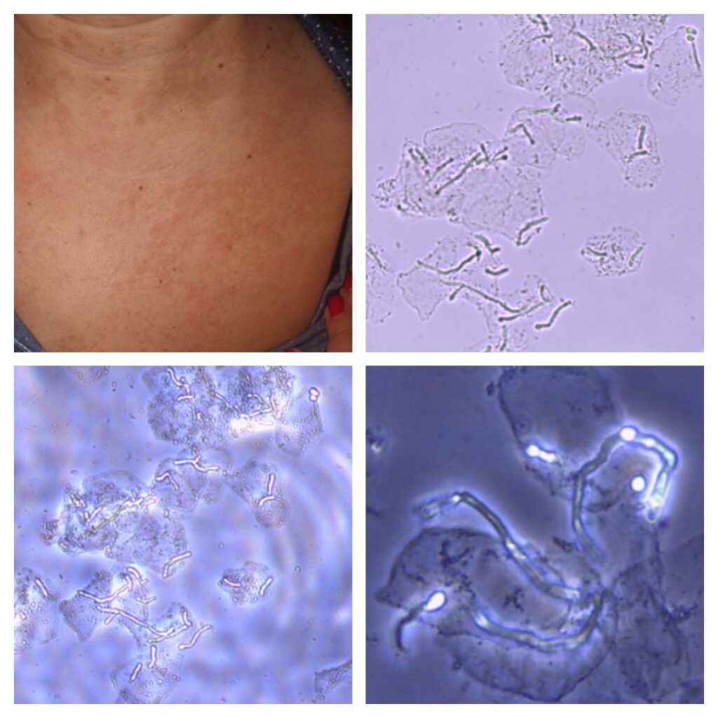 Macchie rosse della pelle durante visita dermatologica con esame microscopico micologico diretto che mostra fungi della pelle