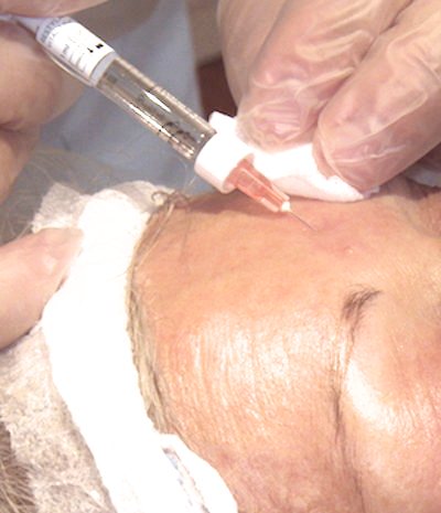 Iniezione di acido ialuronico a livello della fronte di una Paziente durante biorivitalizzazione viso