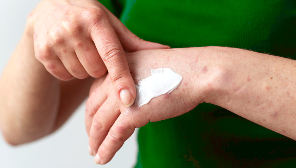 Mani e avambraccia con dermatite atopica, su cui viene spalmata una crema